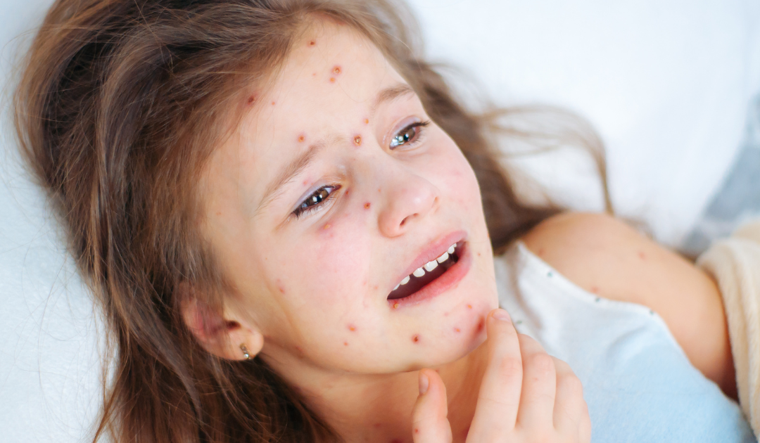 Chickenpox vaccines: what’s the latest?