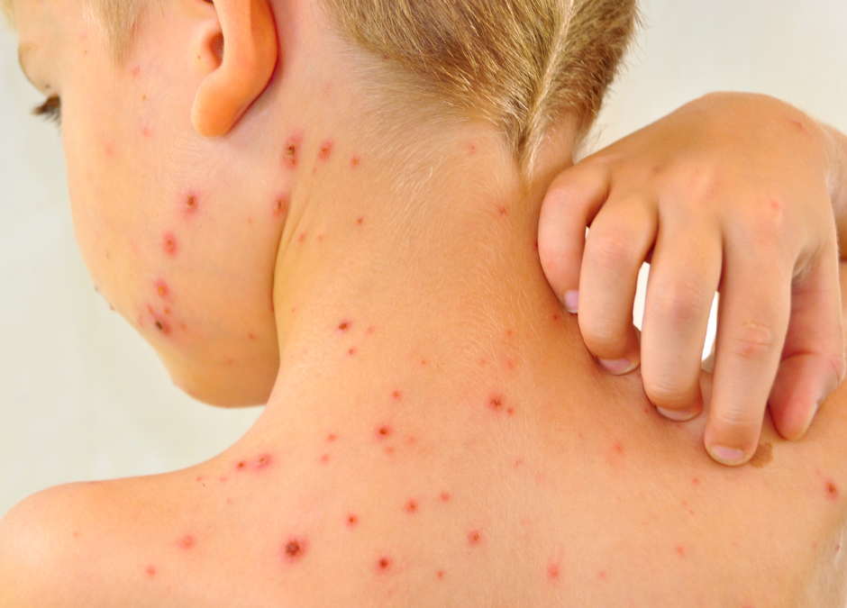 Chickenpox in kids – help is at hand
