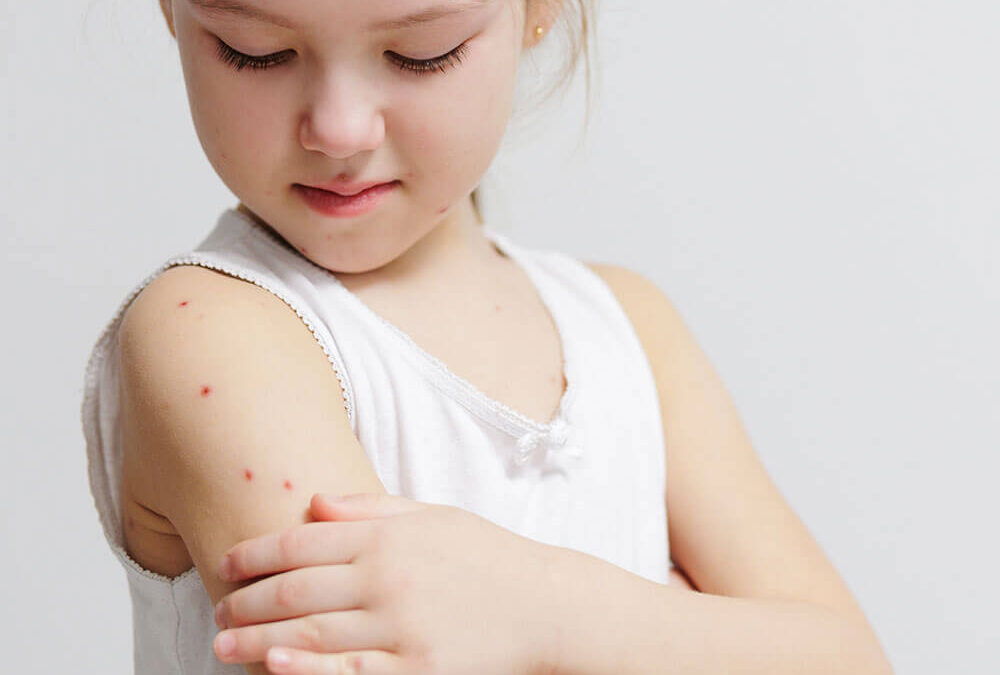 Chickenpox recovery fit-to-fly certificate