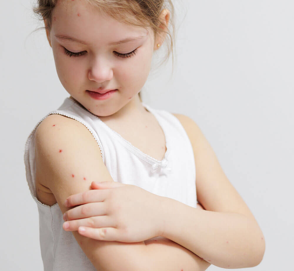 Chickenpox-recovery-in-page-square