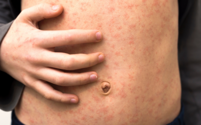 The Measles Warning Signs You Should Know About | ZoomDoc