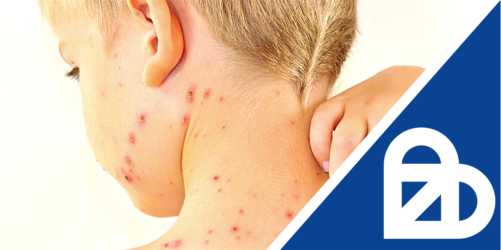 Chickenpox fit to fly recovery certificate