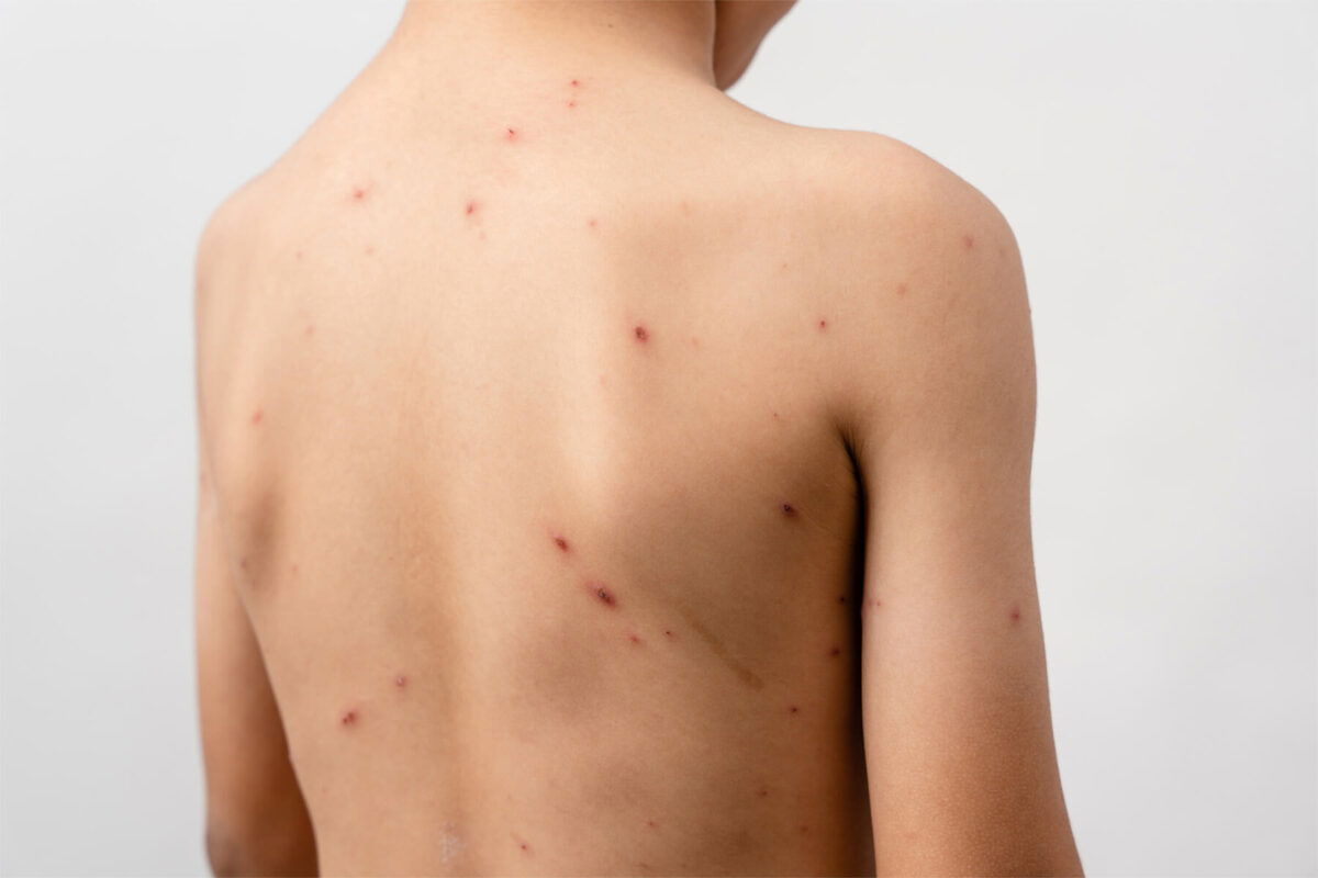 Chickenpox recovery fit-to-fly medical certificate