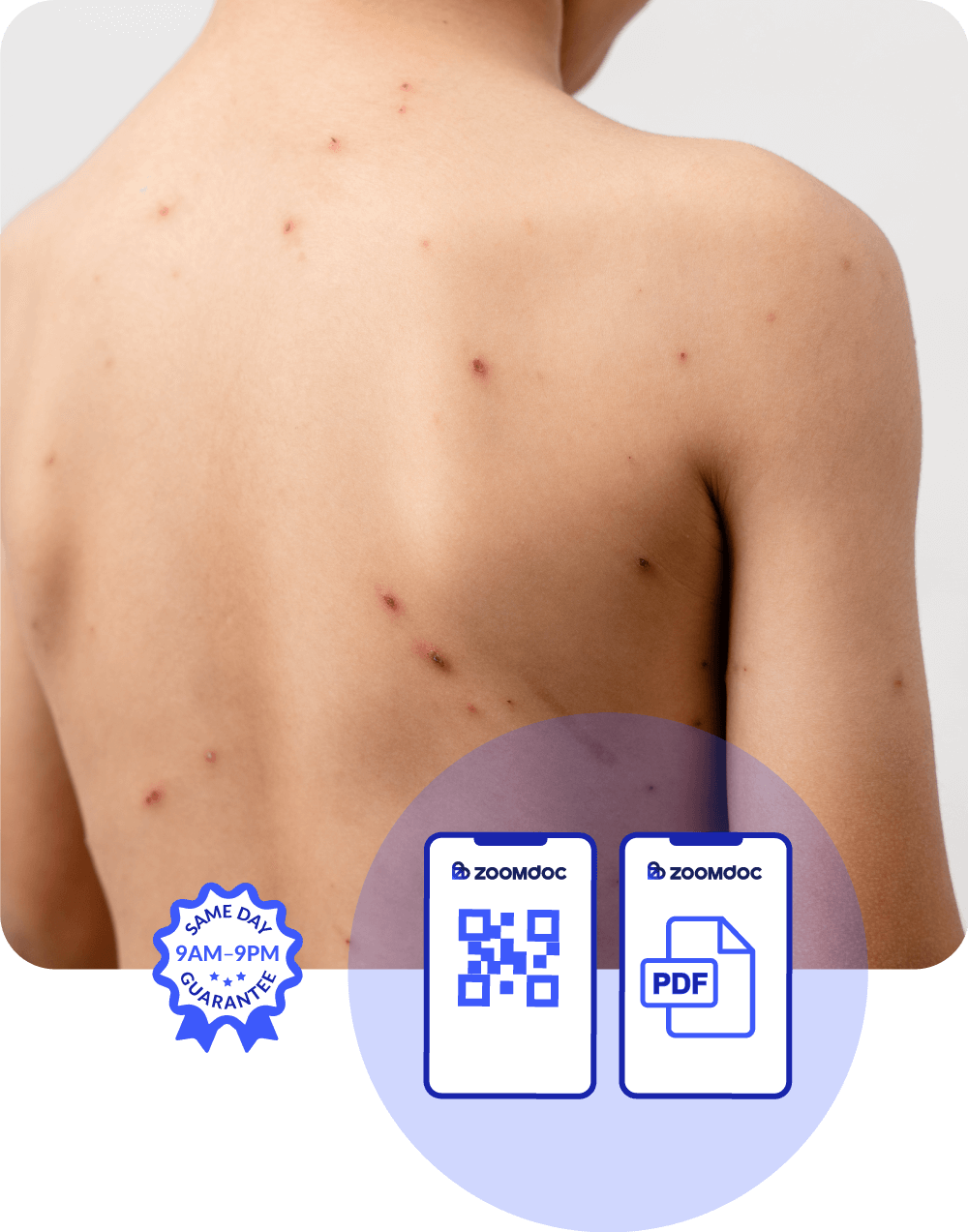 Chickenpox - scabbed over fit-to-fly