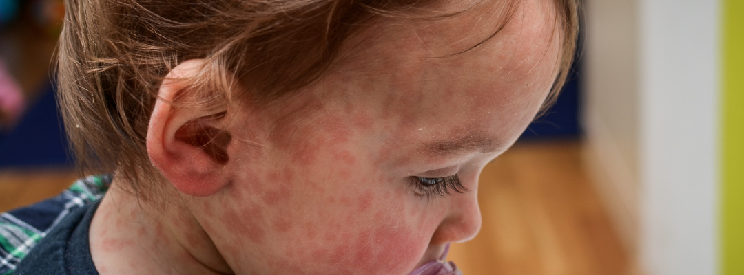 Rise in measles cases is causing concern