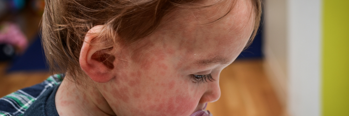 Rise In Measles Cases Is Causing Concern - ZoomDoc Health